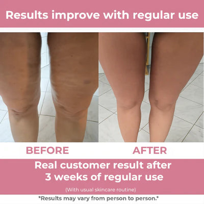 Serouna™ Cellulite Massager