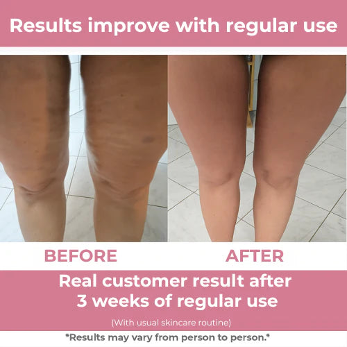 Serouna™ Cellulite Massager